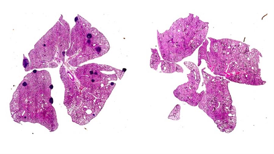 Aspirina podría evitar metástasis en algunos tipos de cáncer