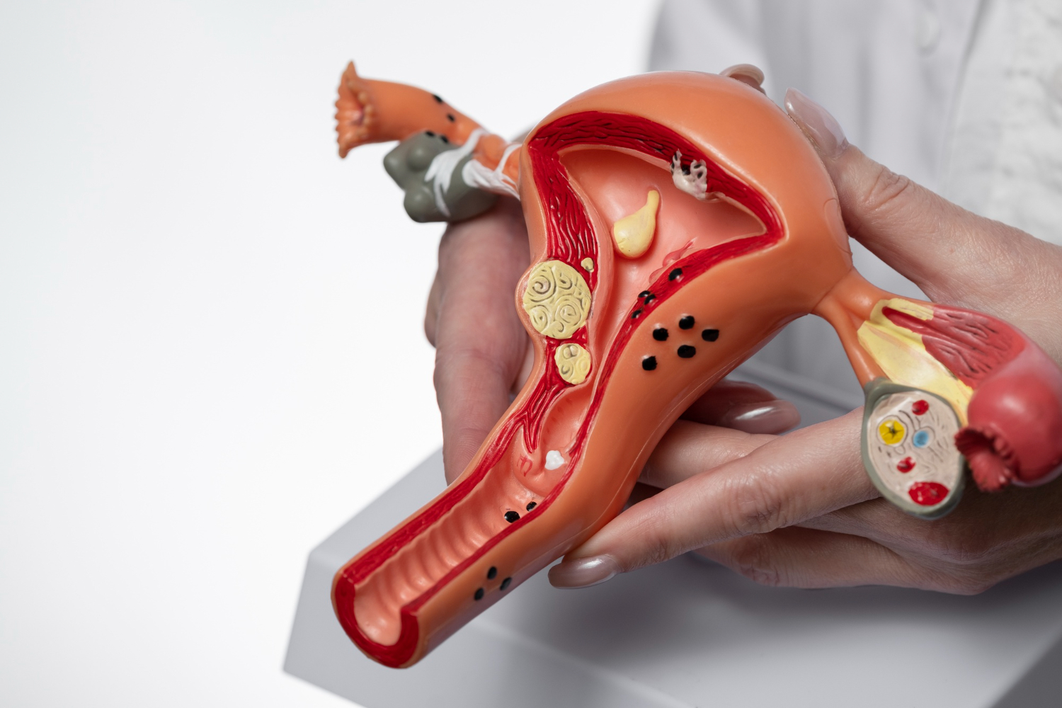 Las muertes por cáncer de cuello uterino caen a cero entre jóvenes vacunadas en Inglaterra