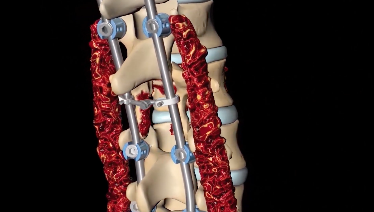 HidroHeal, desarrolla un nuevo tratamiento para fracturas óseas
