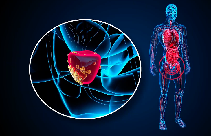Cáncer de próstata, estigmas y mitos afectan su detección temprana