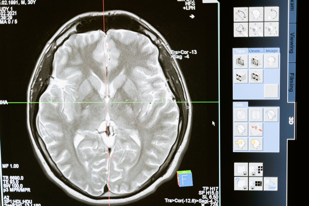 Una nueva tecnología israelí detecta indicios del alzhéimer antes del comienzo de síntomas